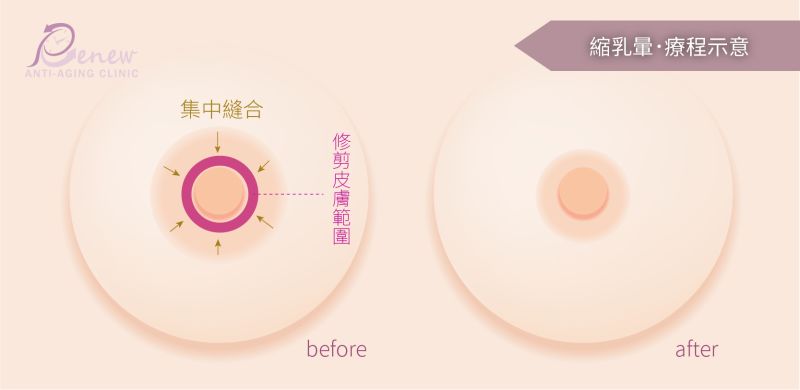 乳房重建－縮乳暈的療程示意圖片 依現前做法，一般乳暈大的狀況下，修除以乳頭為放射狀範圍的皮膚，再集中縫合，即可達成縮小乳暈的目的。