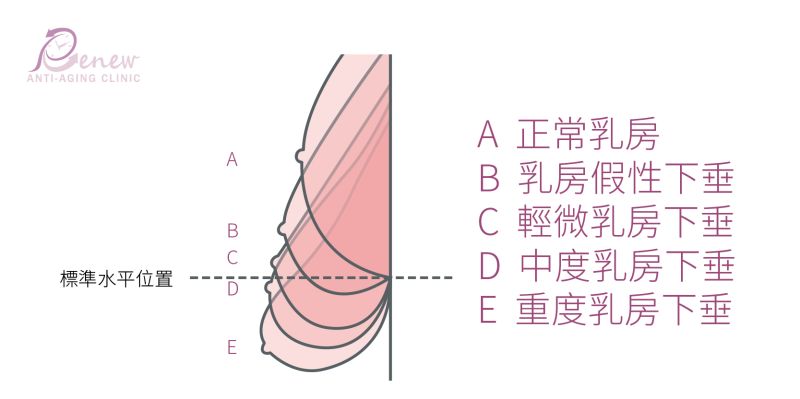 A、B、C級乳房下垂可做「乳暈環切提乳」或「垂直線切提乳」。D、E級乳房下垂可透過做「垂直線切提乳」或「鍾擺式提乳」