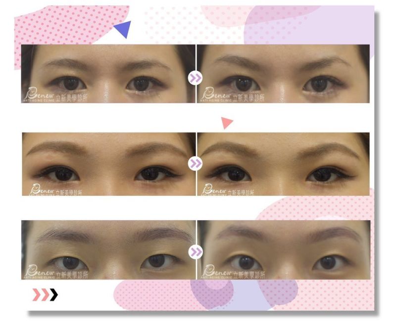 (對比圖)八字靚眼線術前術後照解決眼距太近、眉骨突出無法動雙眼皮、眉尾下垂、沒有眉峰等問題