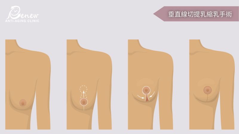 垂直線切提乳（I式提乳）－輕度下垂／僅提乳／術後有疤痕／恢復期短
