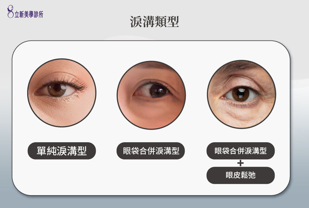 淚溝種類 單純淚溝型 眼袋合併淚溝型 眼袋合併淚溝型+眼皮鬆弛