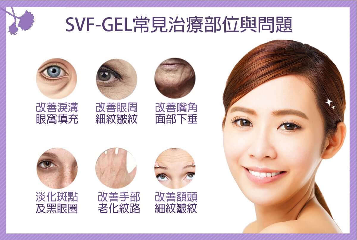 SVF-GEL常見治療部位與問題 改善淚溝眼窩填充 改善眼周細紋皺紋 改善嘴角面部下垂 淡化斑點及黑眼圈 改善手部老化紋路 改善額頭細紋皺紋