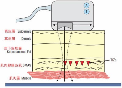Ulthera音波拉皮，目前有三種深度(4.5mm/3.0mm/1.5mm)，主要差異會在於治療深度與治療能量點的長度，其治療深度約3.0mm~4.5 mm， 可以作用到更深部的SMAS層(筋膜層)，因此改善了以往雷射儀器治療深度的限制。加上聚焦超音波作用的每單一能量點(TCP)在皮下作用的溫度較高，是目前所有非侵入式緊膚儀器的最高溫度：其能量不需擔心表皮受傷！