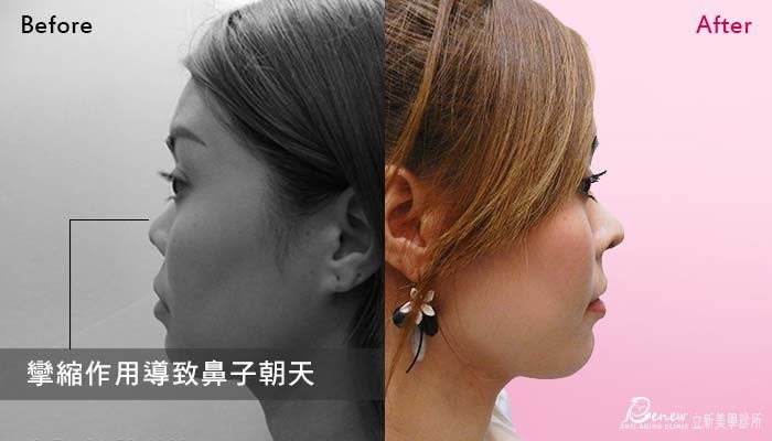 鼻整形修復二步救援，挽回9成以上受創的心靈，結構三段式隆鼻，在鼻樑放入假體，鼻頭放入耳軟骨，鼻中隔延長(對比圖)