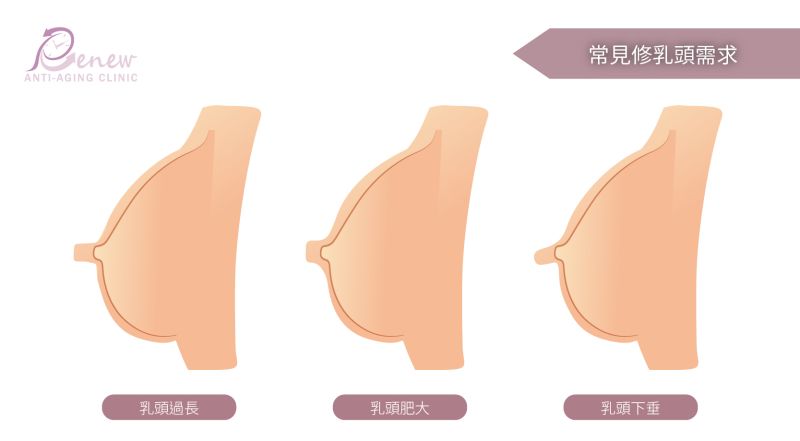 乳房重建－常見的修乳頭需求-乳頭過長-乳頭肥大-乳頭下垂 乳頭有8種類型：巨大型/漏奶型/狹長型/外擴型/疙瘩型/內凹型/多重型/毛毛型