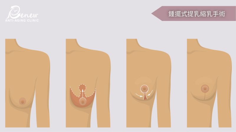 鍾擺式提乳（傳統倒T提乳）－中度下垂／可縮小乳房／術後有疤痕／恢復期中長